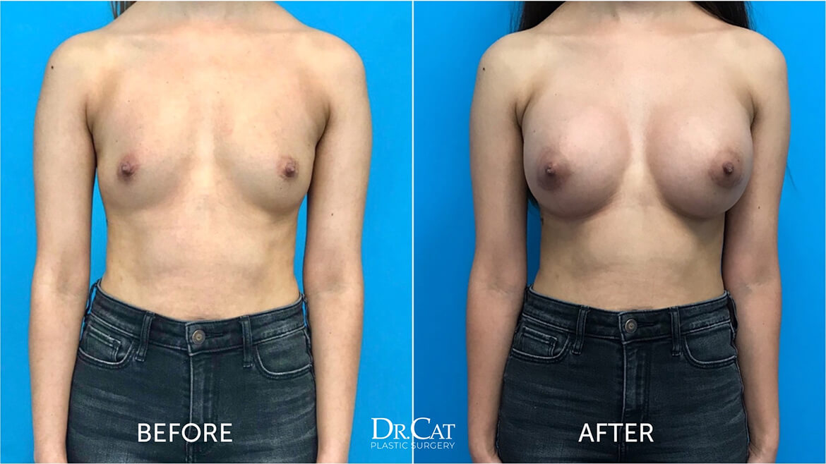 Breast Augmentation: Before, During, and After Surgery