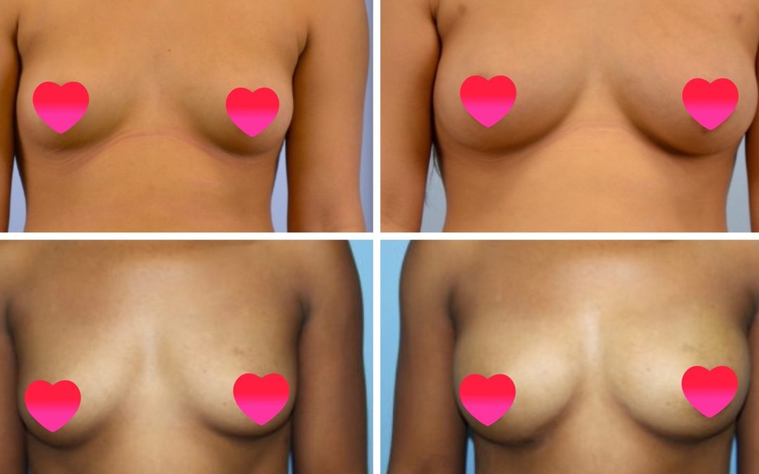 breast augmentation with fat transfer banner photo