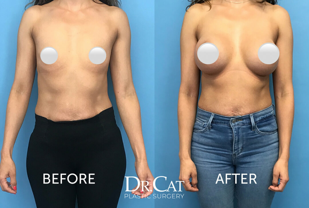 Am I too skinny for breast implants? (Photo)