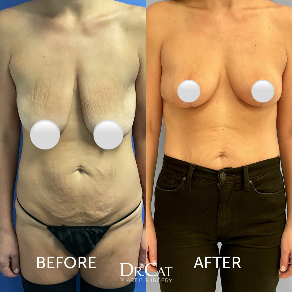 Breast Lift Surgery After Pregnancy