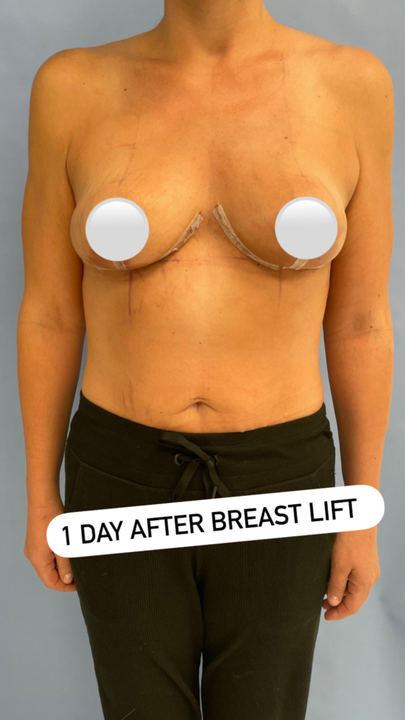What is a Breast Lift with Implants Over the Muscle