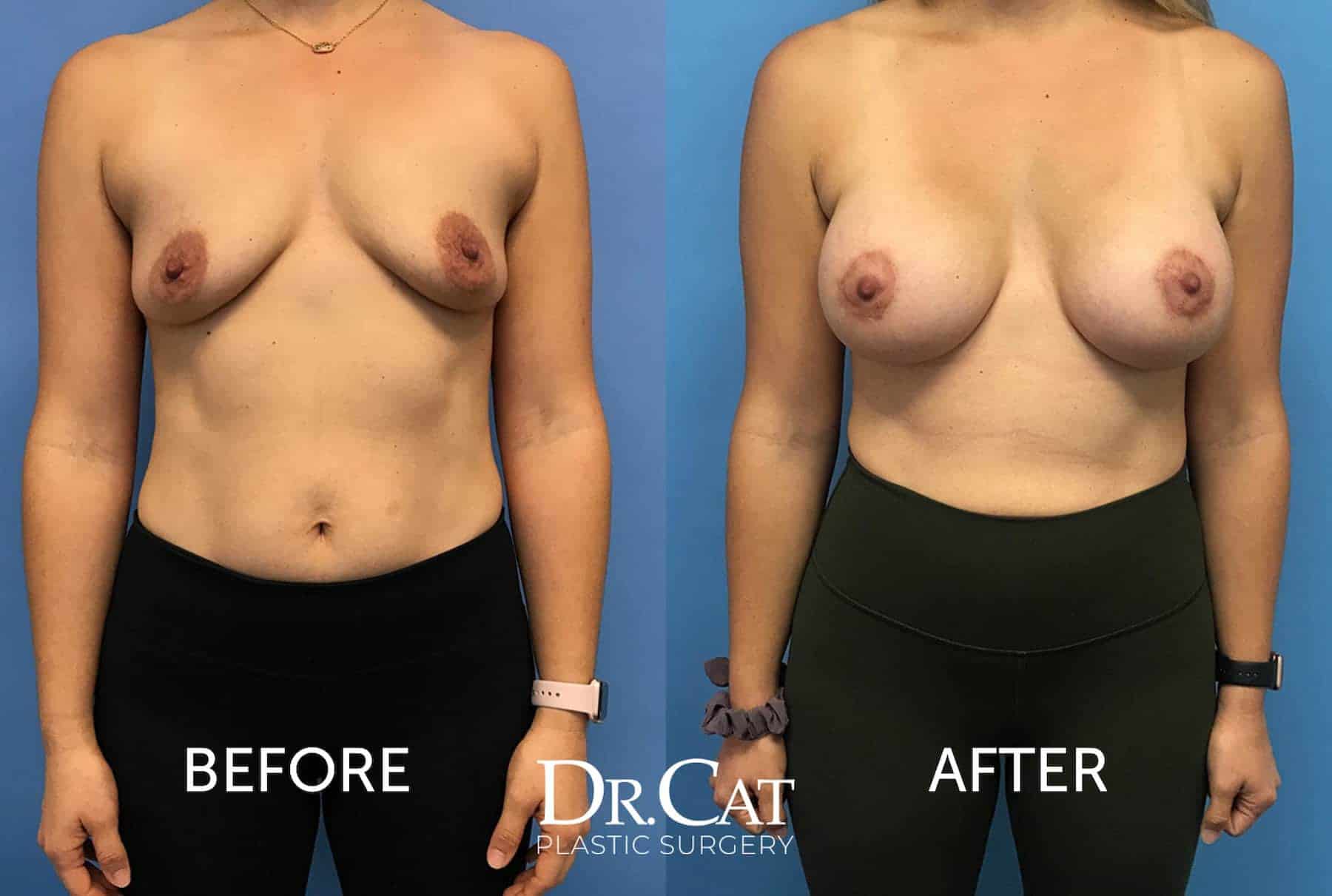Breast lift before and after Dr. Cat