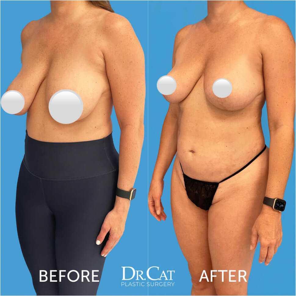 These breasts were reduced, lifted and reshaped with natural