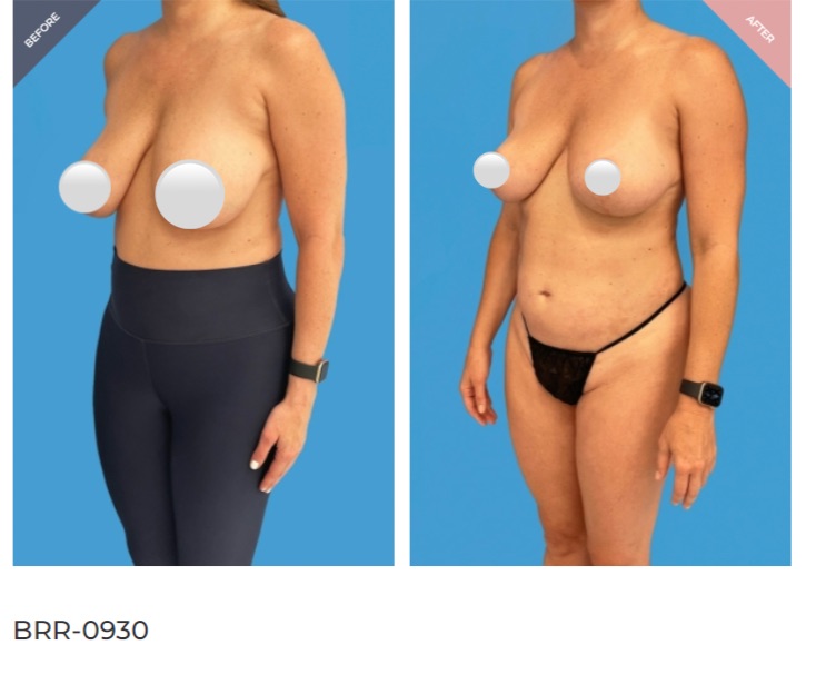 Breast reduction surgery before and after