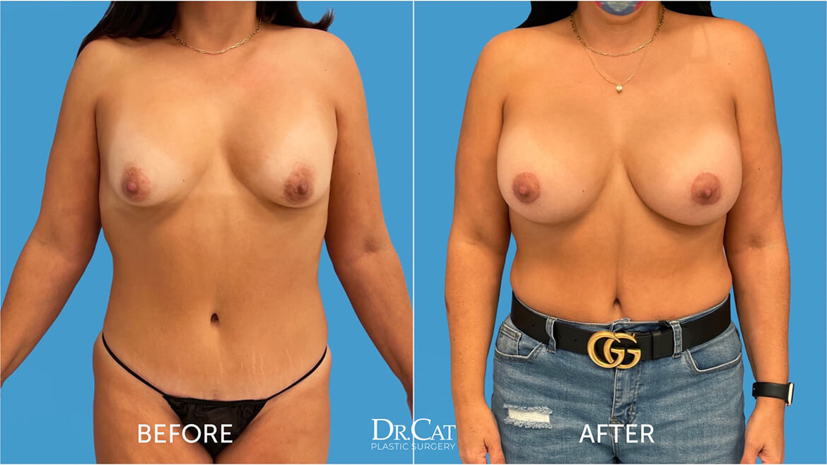 Breast Revision Surgery Before and After