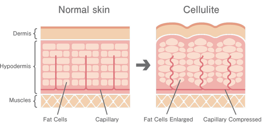 how cellulites are formed