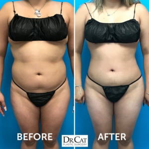 Liposuction Before and After Dr. Cat