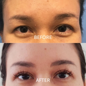 eyelid lift before and after