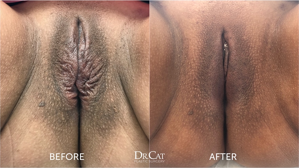 Extra skin after weight loss