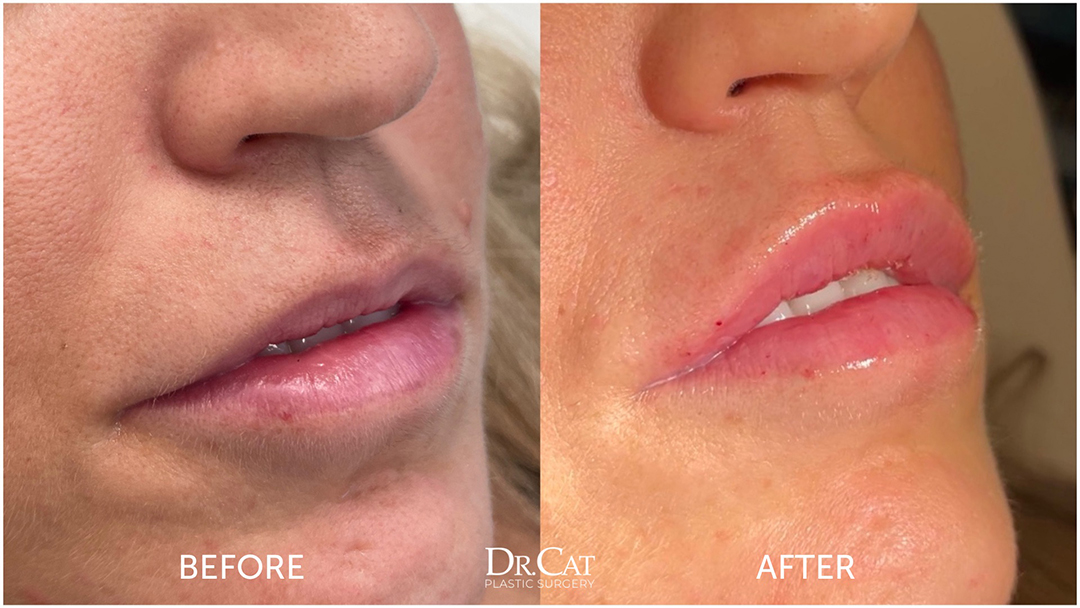 Fat grafting facial contouring procedure - Dr. Cat