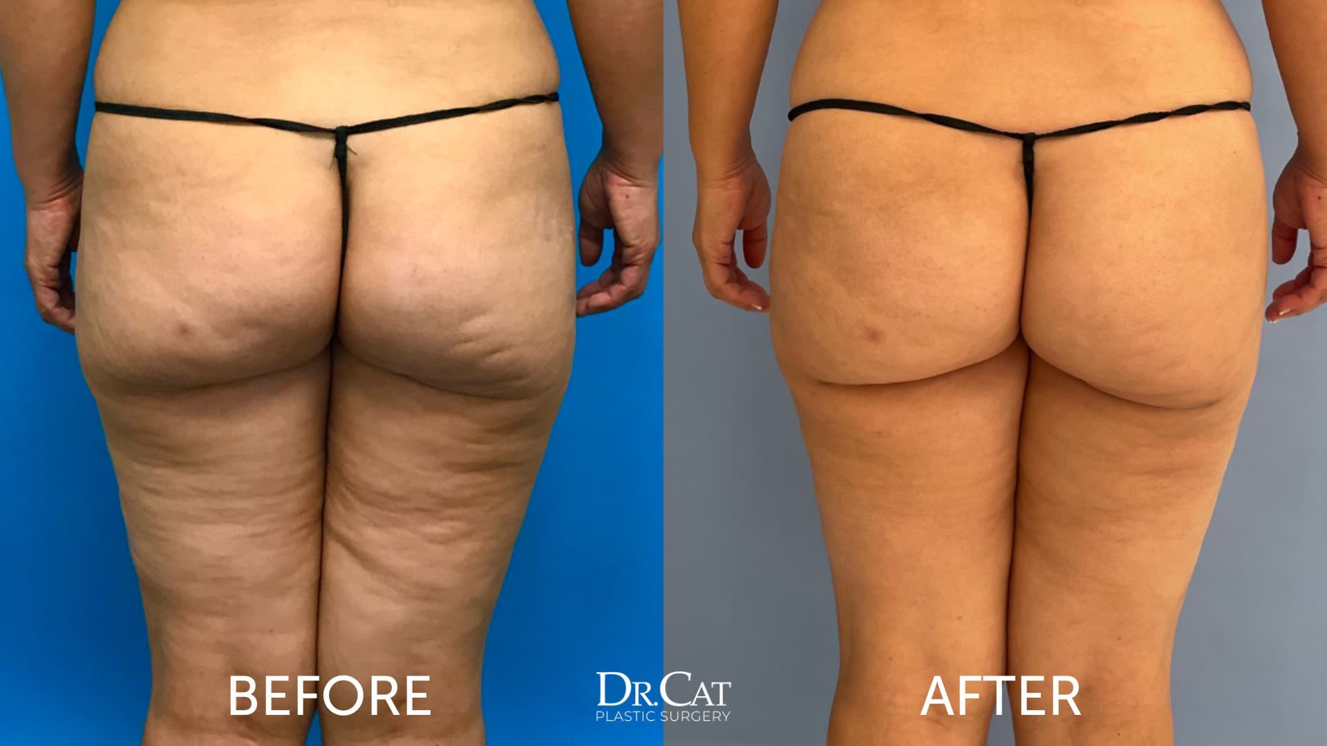 Hacks for Getting Rid of Cellulite: Smooth Body Contours
