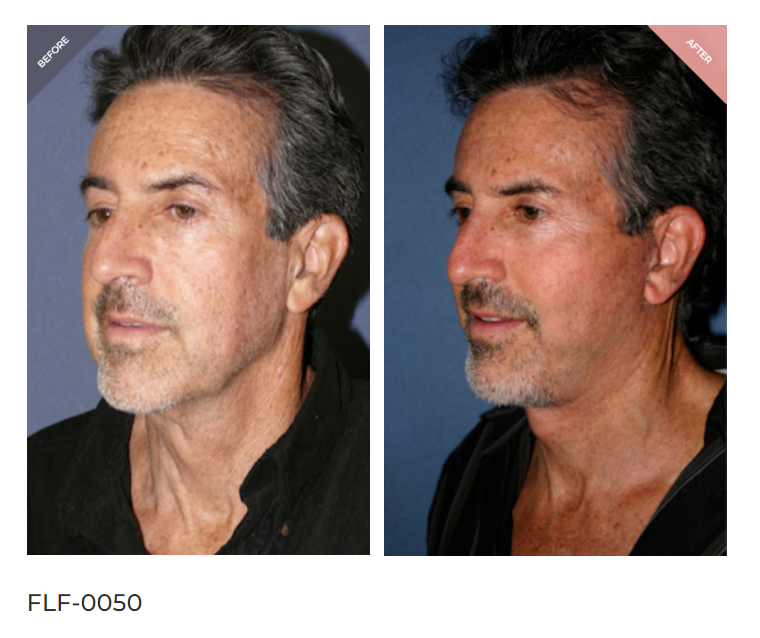 Facelift recovery before and after results showing natural rejuvenation by Dr. Cat