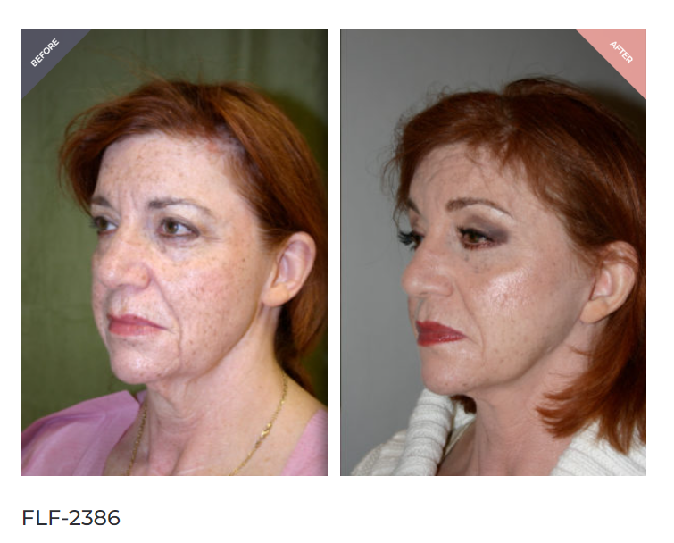 Facelift recovery week 1 showing post-op healing and drain removal
