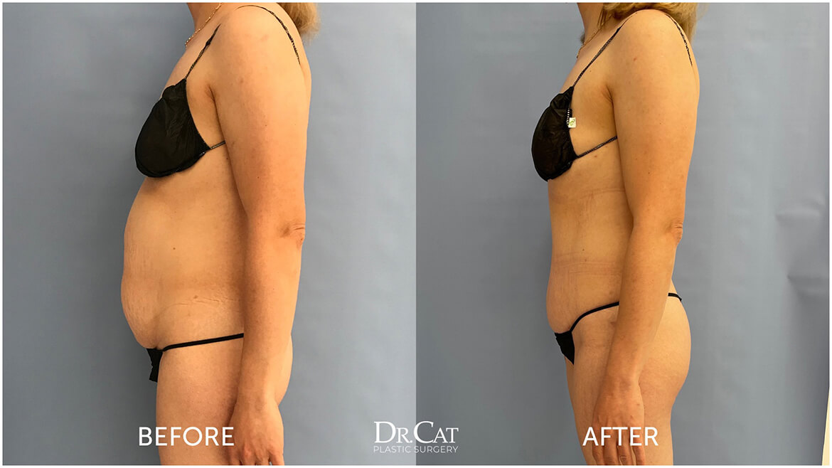 Health benefits of tummy tuck