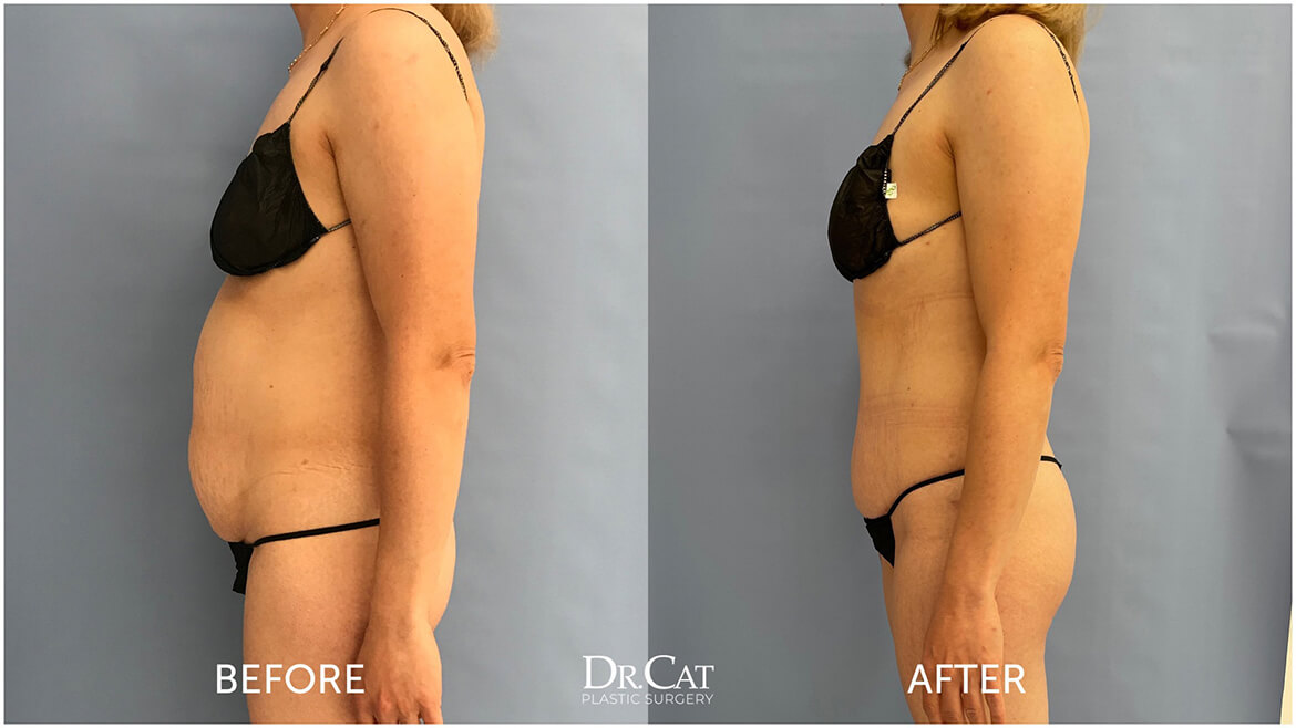 Muscle Repair in Tummy Tuck Changes Recovery: Here's How