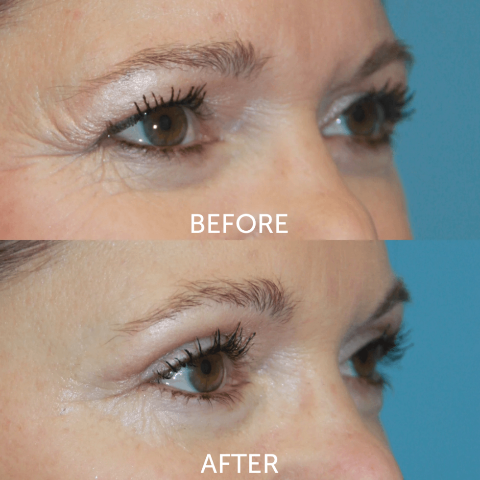 Hooded Eyes Causes Treatments And Fixes Dr Cat 9353