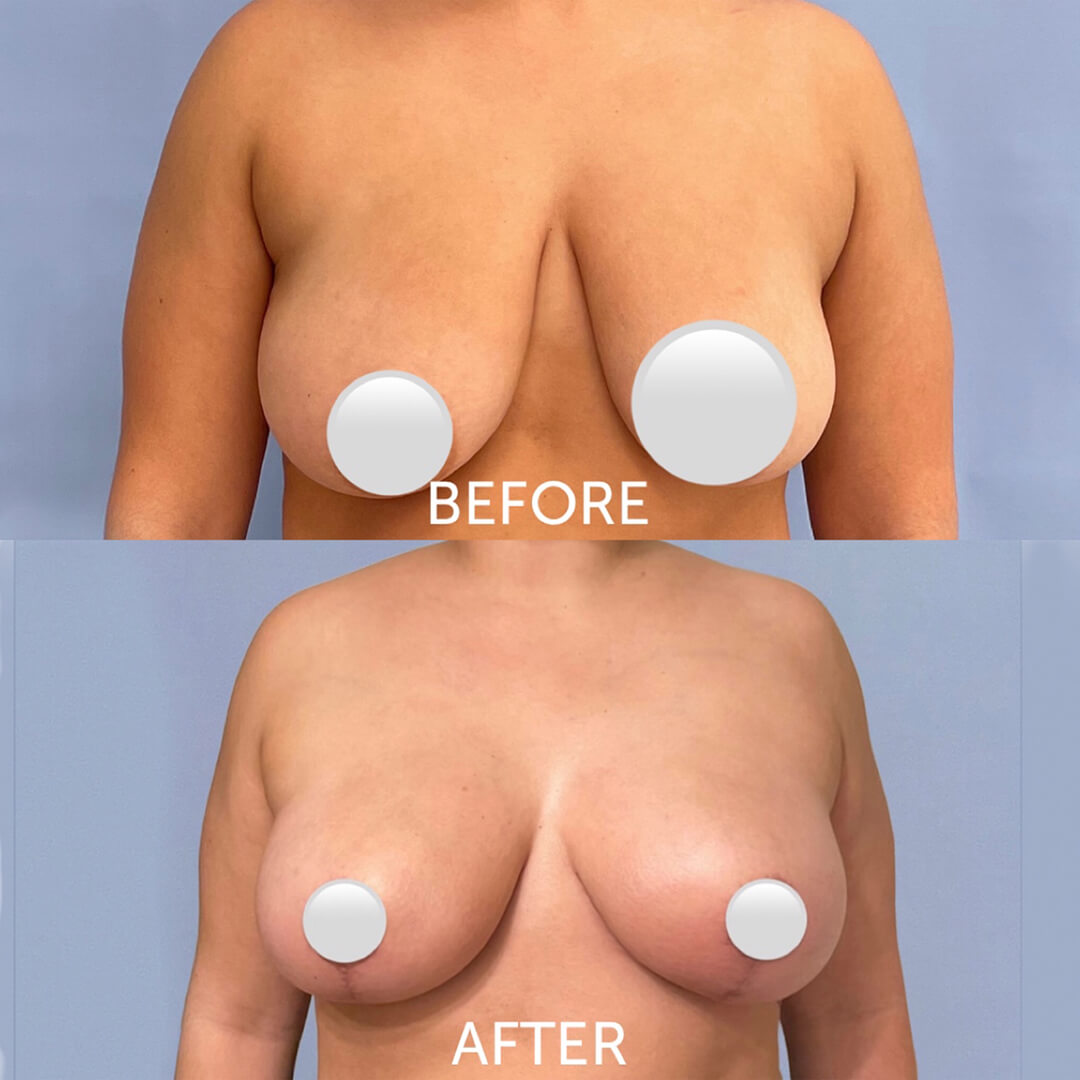 How Breast Lift and Breast Reduction Can Help Large Breasts