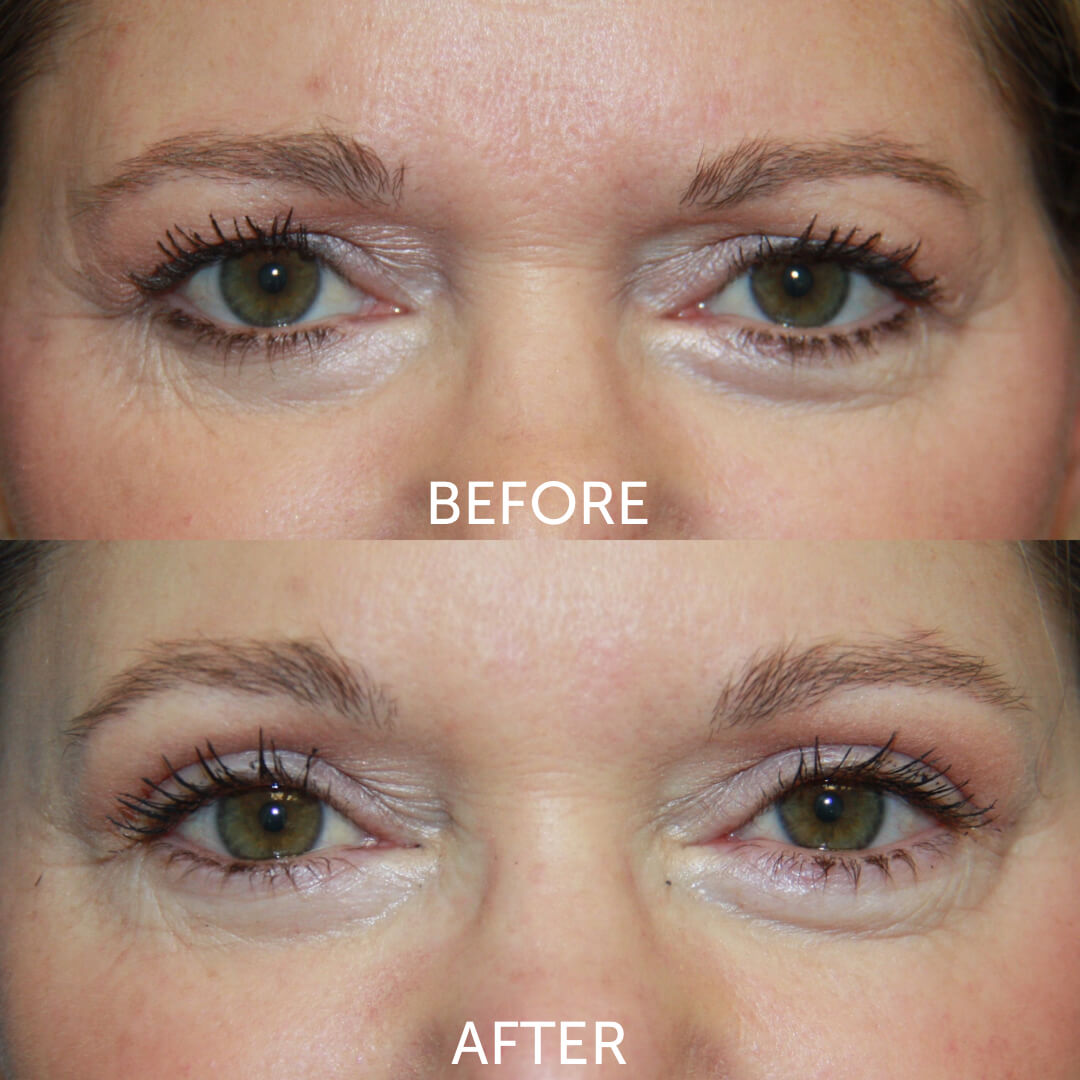 Before and after eyelid lift
