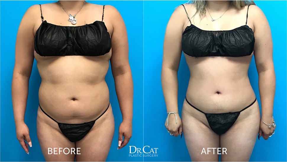 Successful liposuction case study before and after
