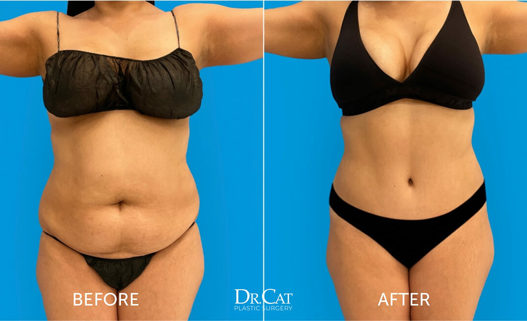 Maximizing Mini Tummy Tuck Results