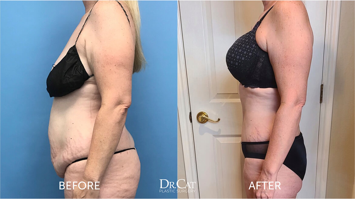 Tummy tuck results before and after