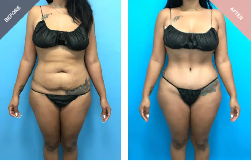 A side by side photo of a before and after of a patient’s staged Mommy Makeover Recovery Timeline.