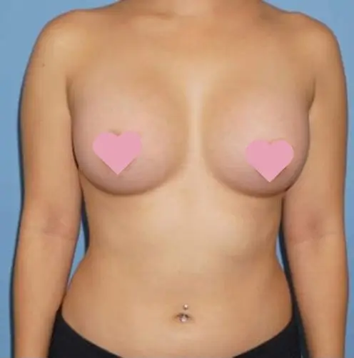 C Cup Breast Implant Size 