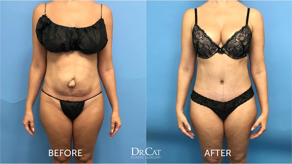 Tummy tuck results showing abdominal contouring after panniculectomy vs tummy tuck consultation