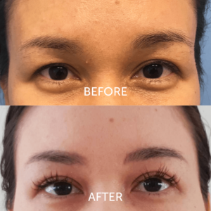 Hooded eyes blepharoplasty before and after