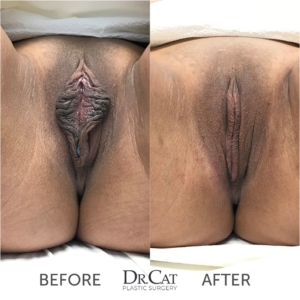Labiaplasty Before and After 