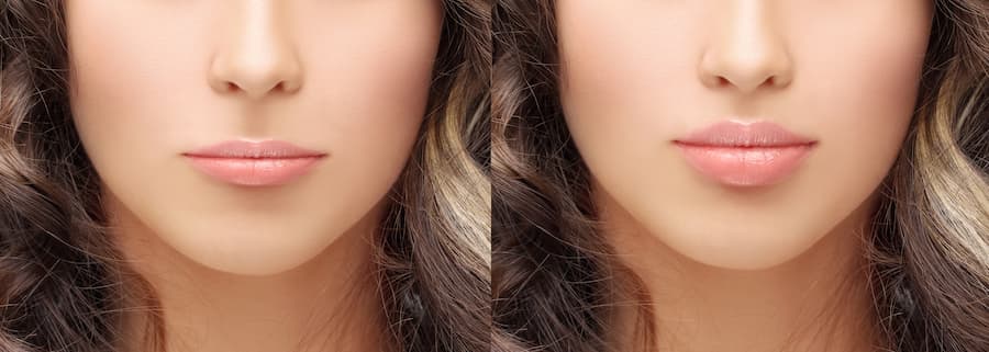 Lip Lift Before and After