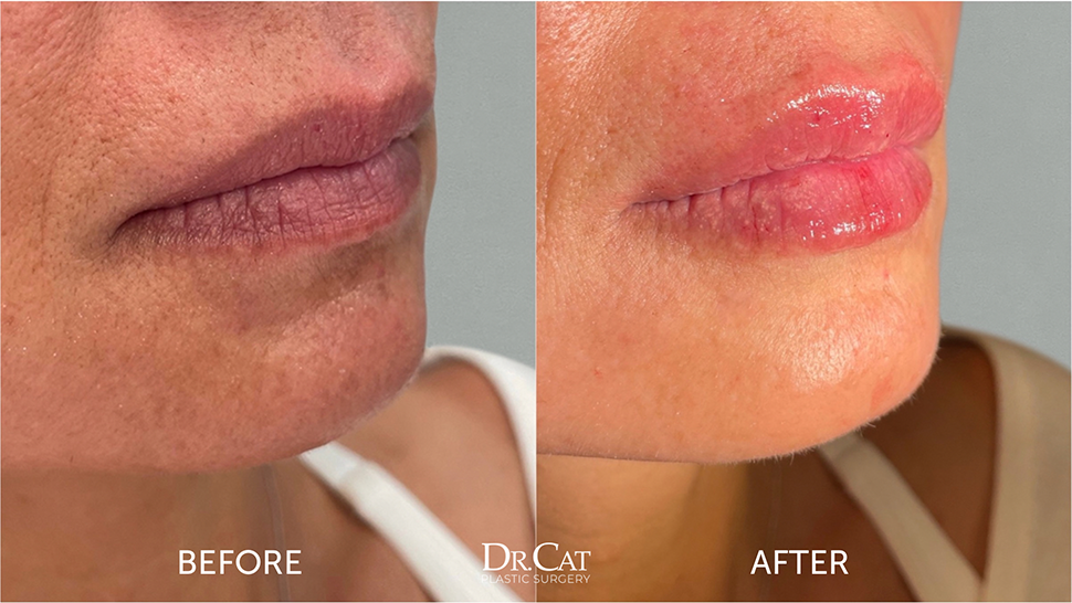 Lip filler before and after results at Dr. Cat Beverly Hills