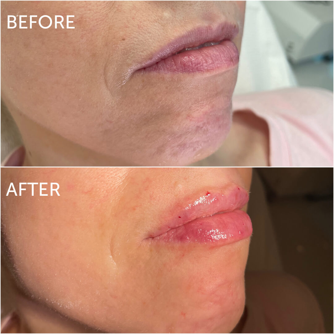 Lip filler swelling stages