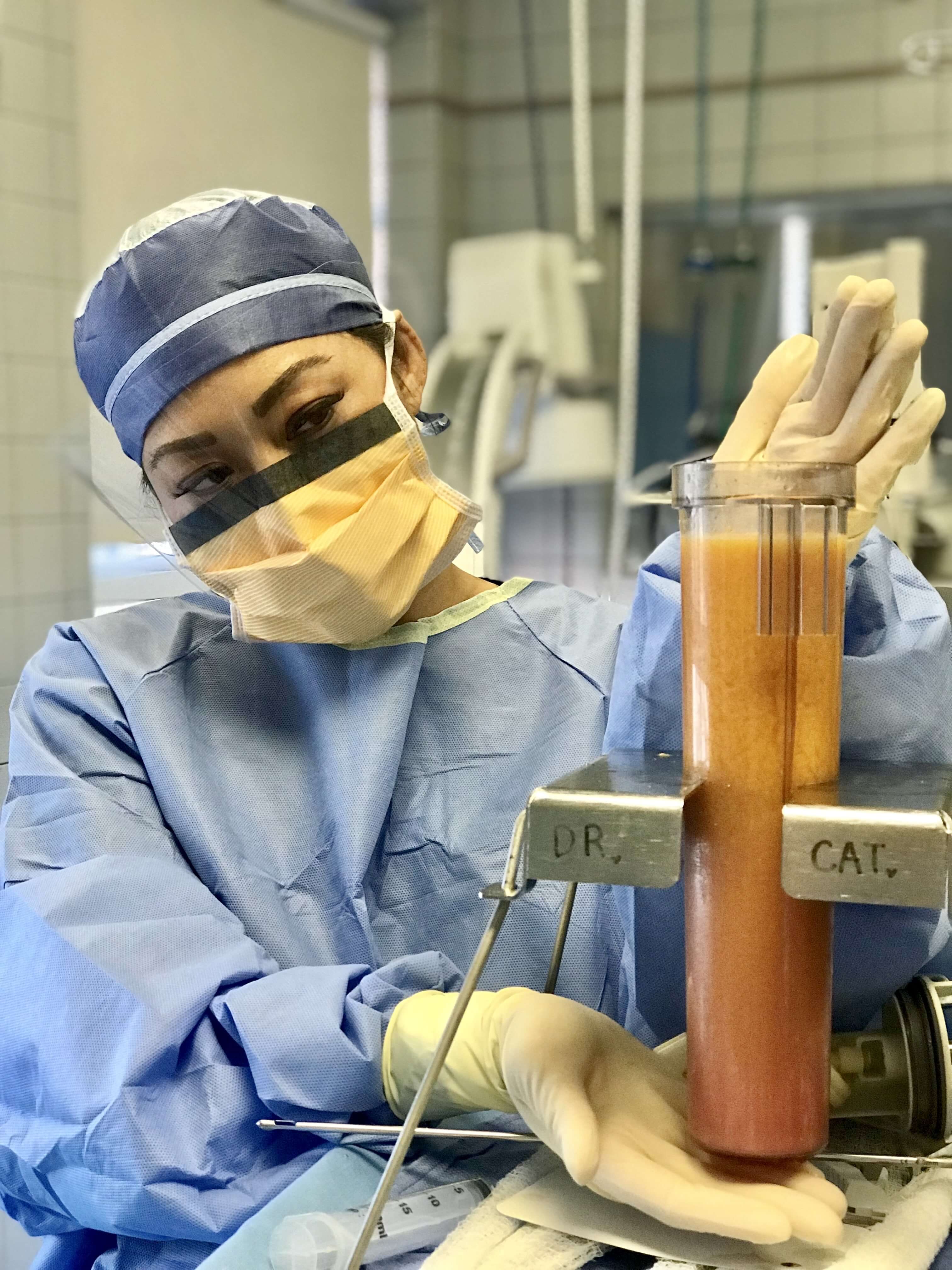 Dr. Cat Liposuction Technique