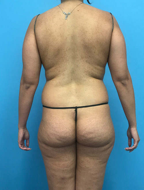 Patient #3957 Brazilian Butt Lift Before and After Photos Pomona