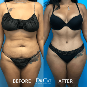 Dr. Cat Liposuction Results 