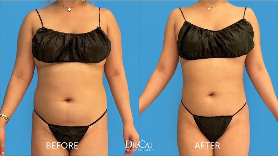 5 Common Facts About Liposuction - Garza Plastic Surgery