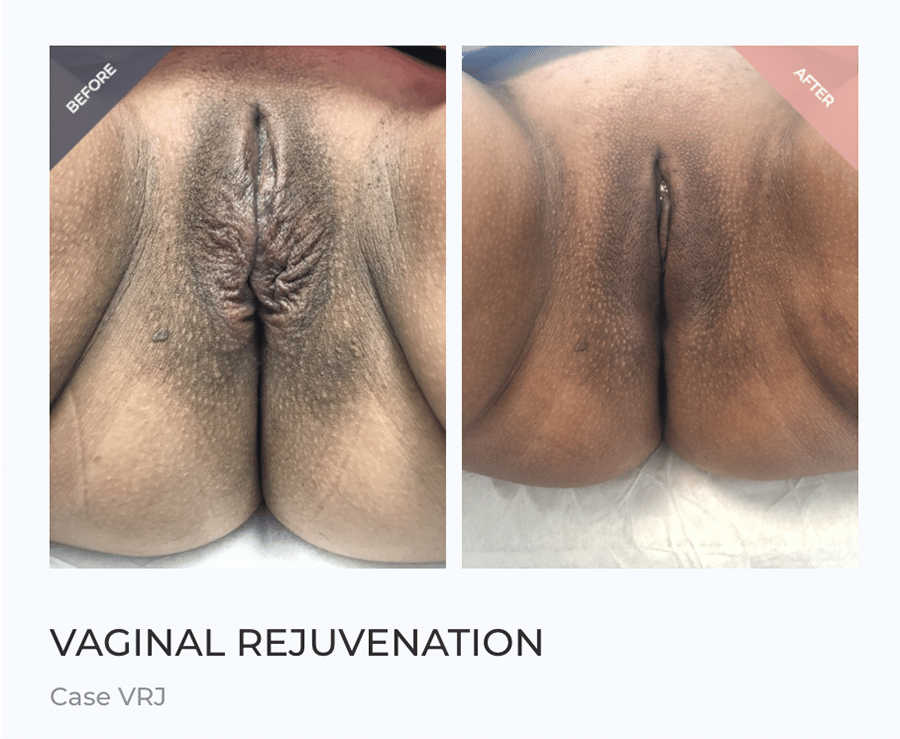 Tighten Vaginal Skin Before and After