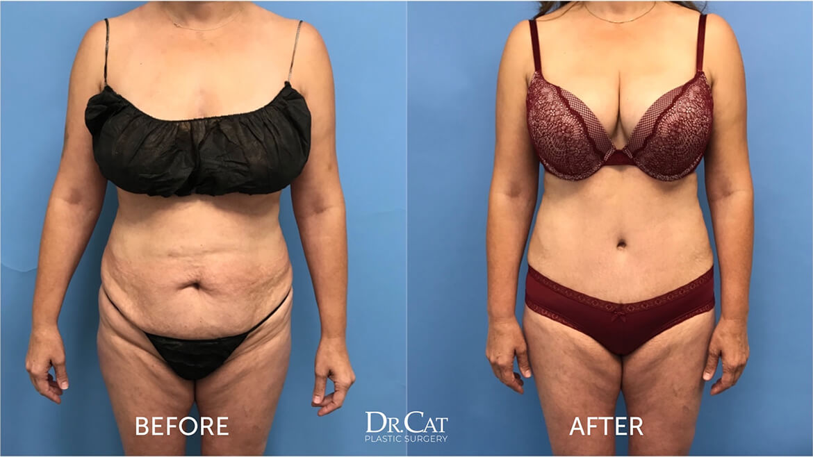 The benefits of TUMMY TUCK may be more than just a trim tummy