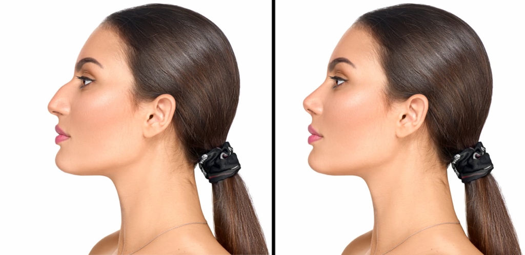 Middle Eastern Rhinoplasty in Beverly Hills