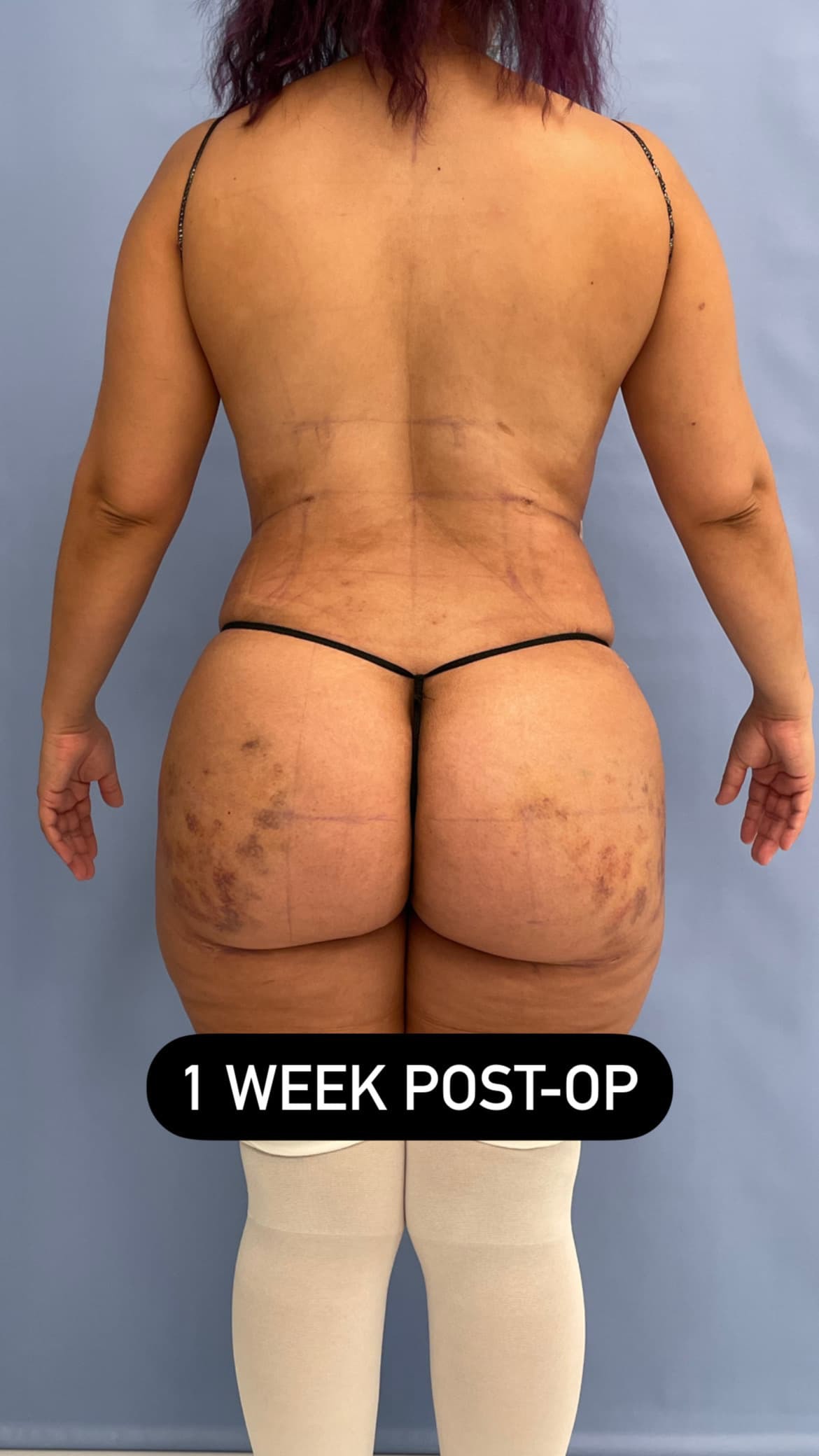 BBL recovery at one week: bruising over the buttocks and lower back, back view of a Dr. Cat patient