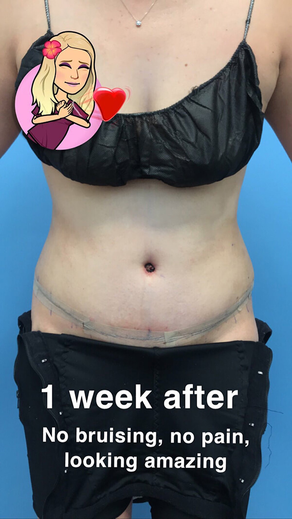 One week tummy tuck recovery timeline showing post-op healing progress