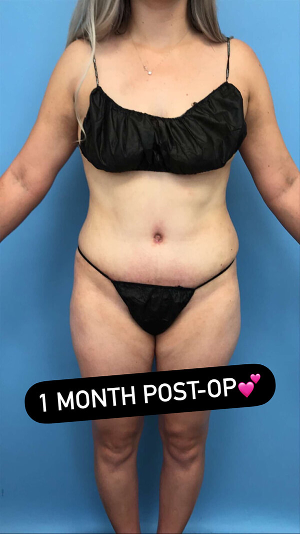 One month tummy tuck recovery timeline results showing flat abdomen