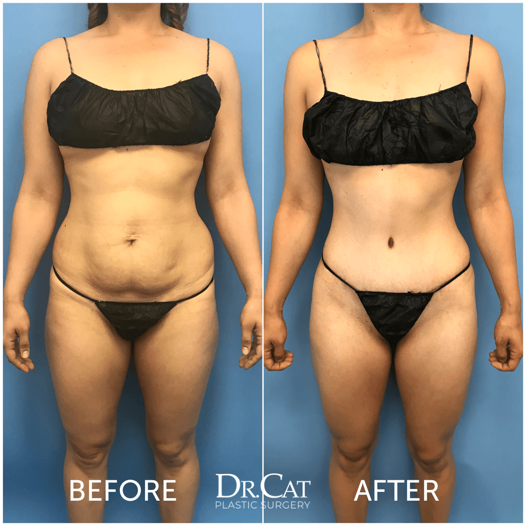 Tummy tuck before and after by Dr. Cat, front view: a soft, protruding lower abdomen before and a flat, even abdominal wall after