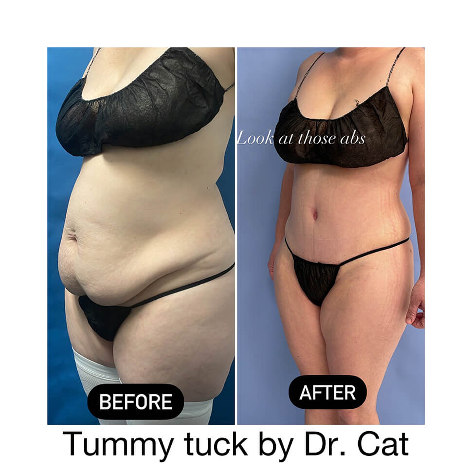 can you get lipo during c section Can You Get Tummy Tuck During C-Section 2026 main image 0