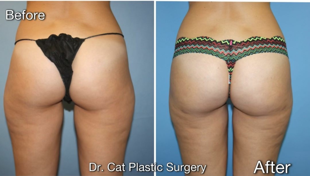 Severe hip dips and saddle bag? Liposuction : r/PlasticSurgery