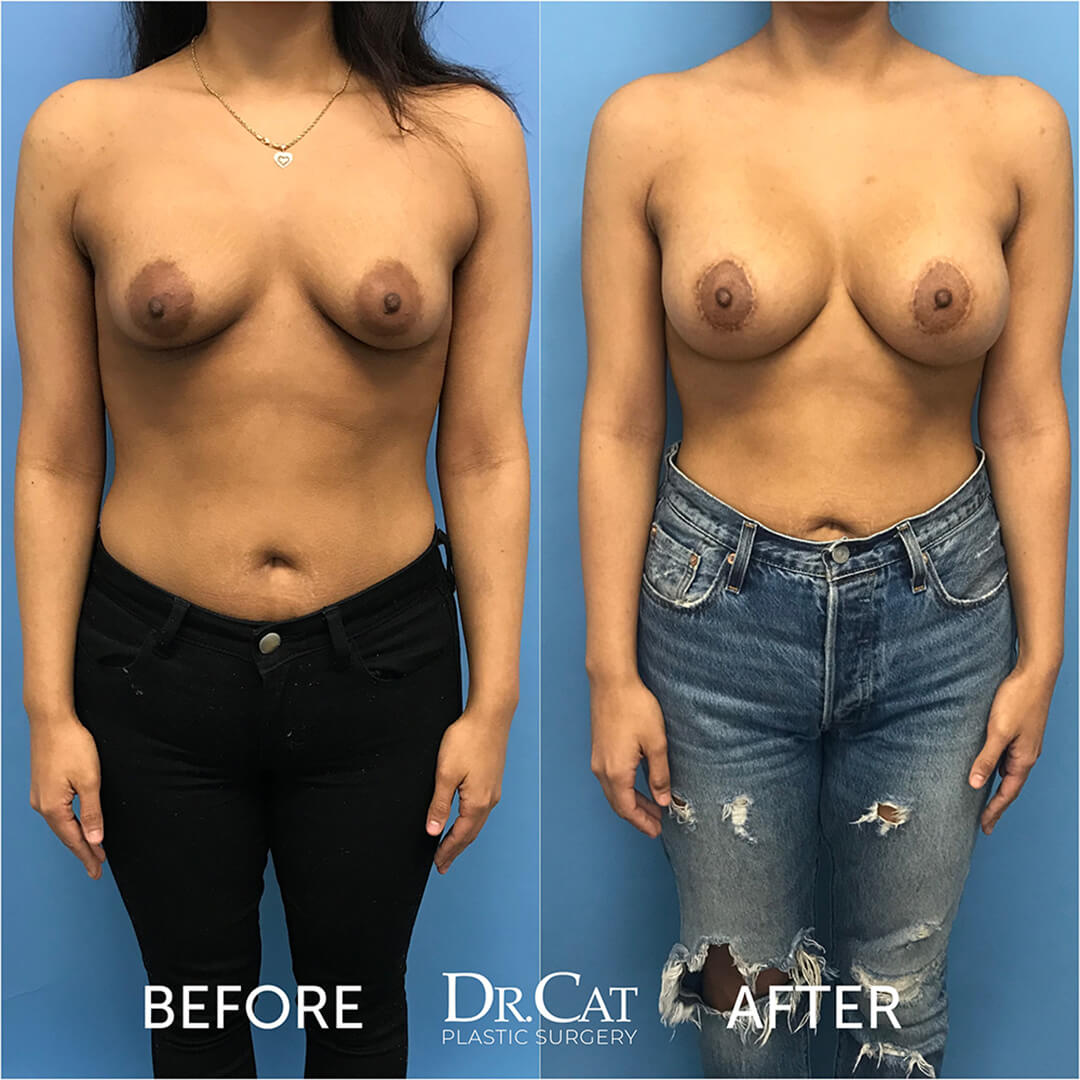 Puffy nipples reduction before and after