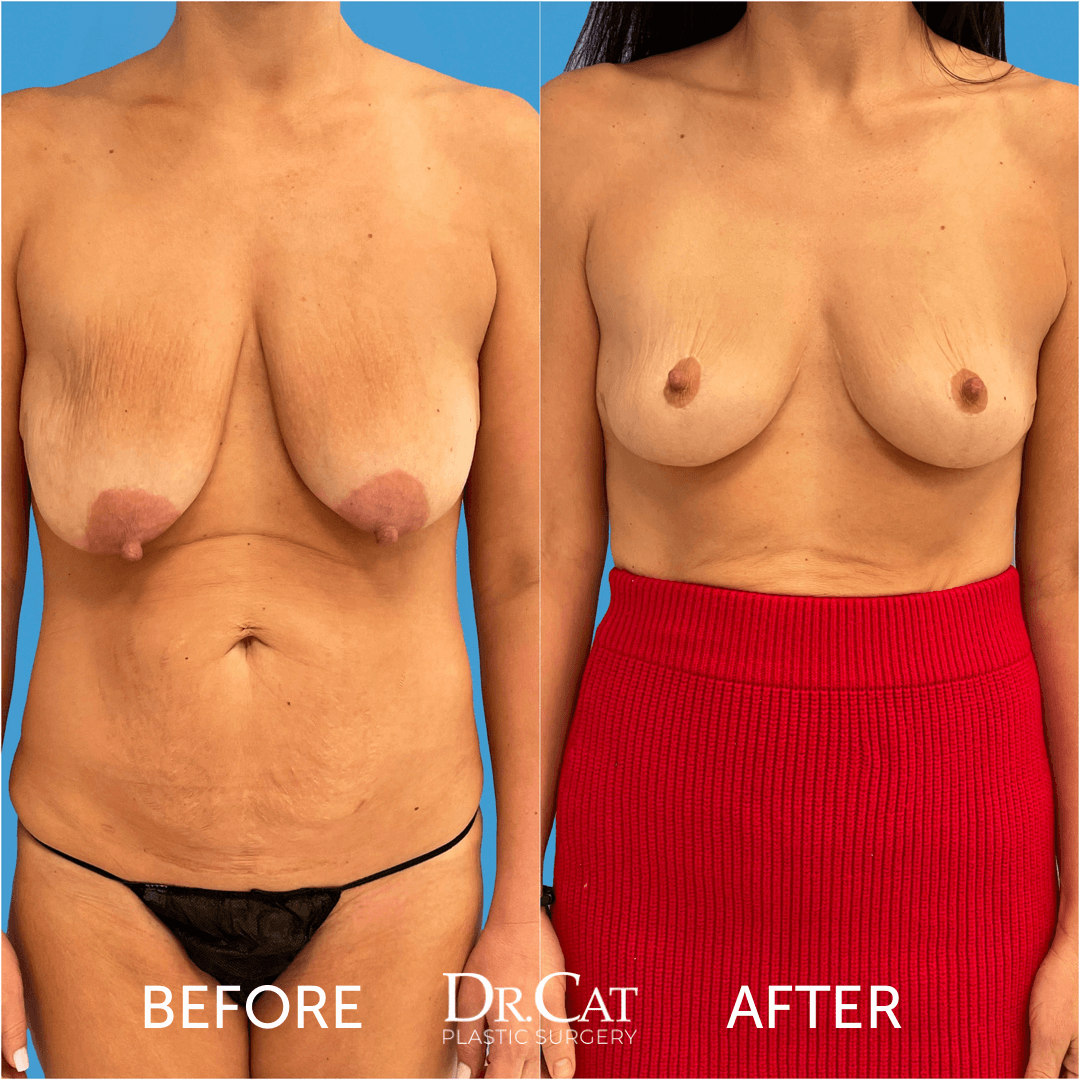 Recovery after breast surgery for saggy boobs correction