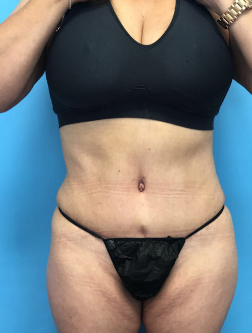 Revision Tummy Tuck - Dr. Cat Begovic, Beverly Hills