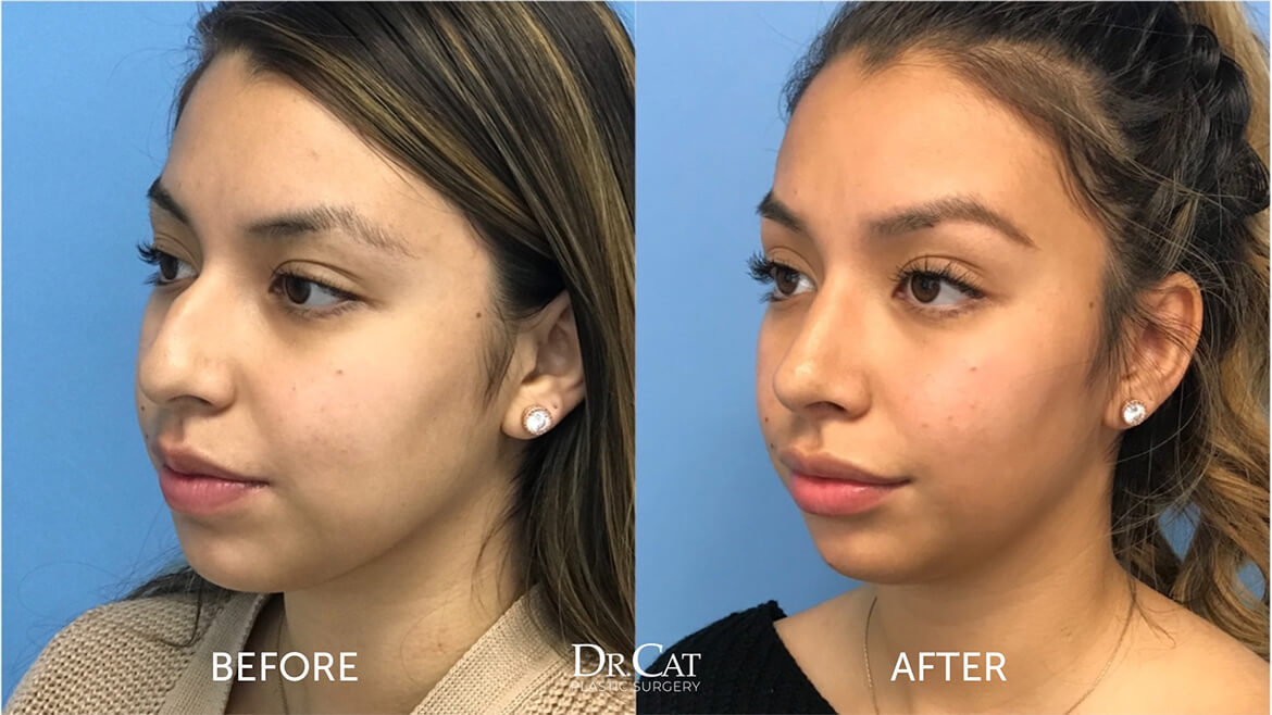 Rhinoplasty before and after results showing a refined nasal shape after recovery